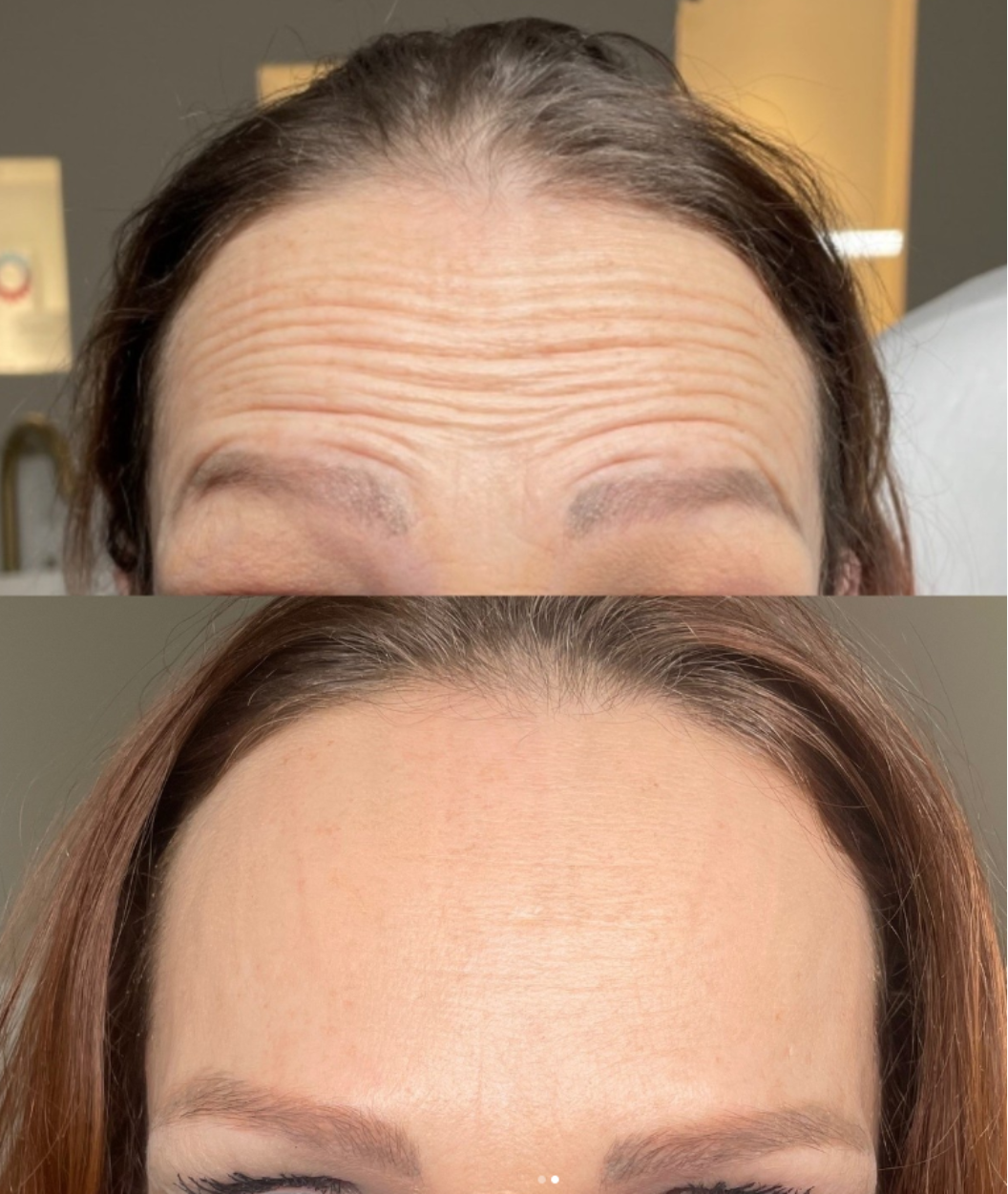 botox resultater før og efter
