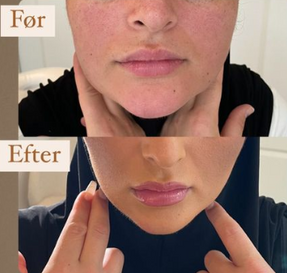 botox ved kæben og halsen før og efter