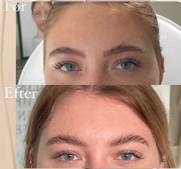 Botox i panden før og efter 